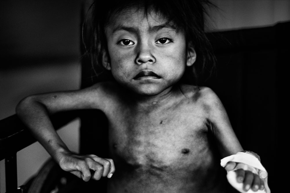 Guatemala: Gezeichnet durch chronische Unterernährung | ©JM Lopez/Freier Fotograf Guatemala: Gezeichnet durch chronische Unterernährung