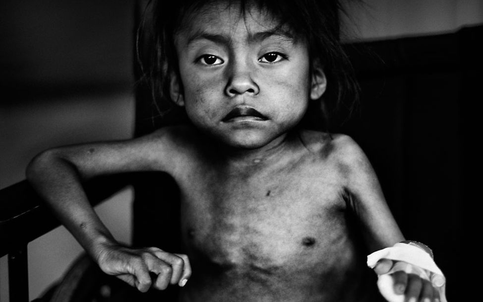 Guatemala: Marked by malnutrition