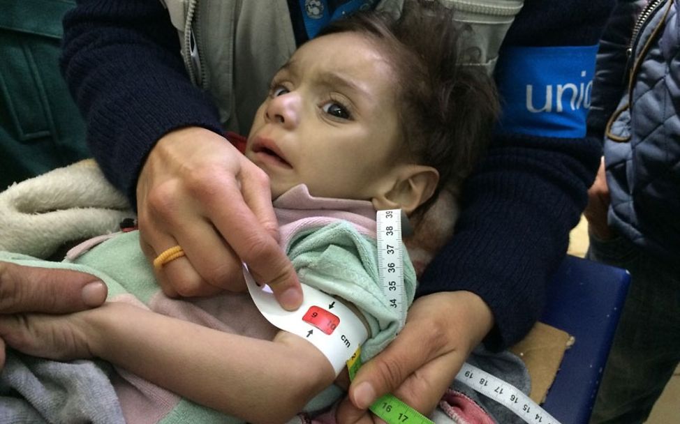 Syrien Madaya: Hungerndes Kind bei Untersuchung durch UNICEF