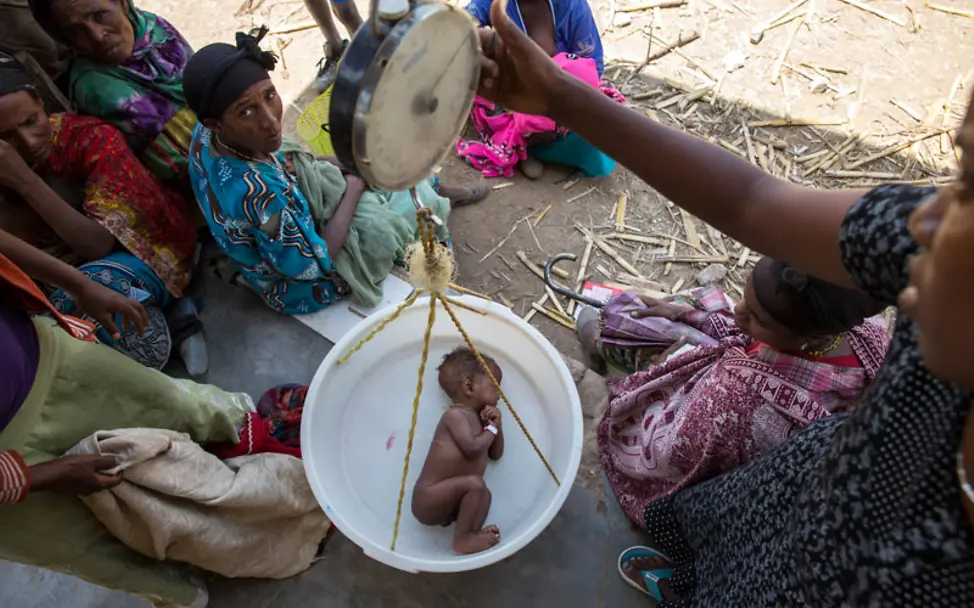 El Niño Äthiopien: Mangelernährung bei mehr als 400.00 Babys | © UNICEF/Ayene El Niño Äthiopien: Ein unterernährtes Kind liegt in der UNICEF Hängewaage.