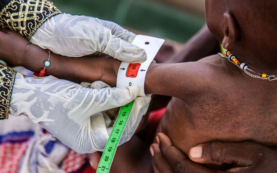 Hungersnot: Ein mangelernährtes Kind in Nigeria