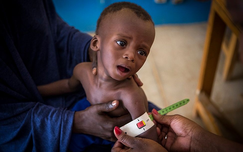 Hungerkrise Sahelzone: Okachatata aus Mali bei einer Untersuchung auf Mangelernährung