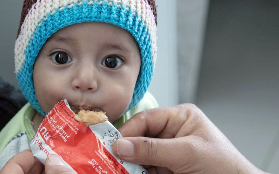 Ein mangelernährtes Kleinkind im Jemen bekommt Erdnusspaste gegen den Hunger.