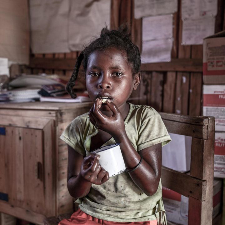 Hunger in Madagaskar: Ein mangelernährtes Mädchen im Gesundheitszentrum