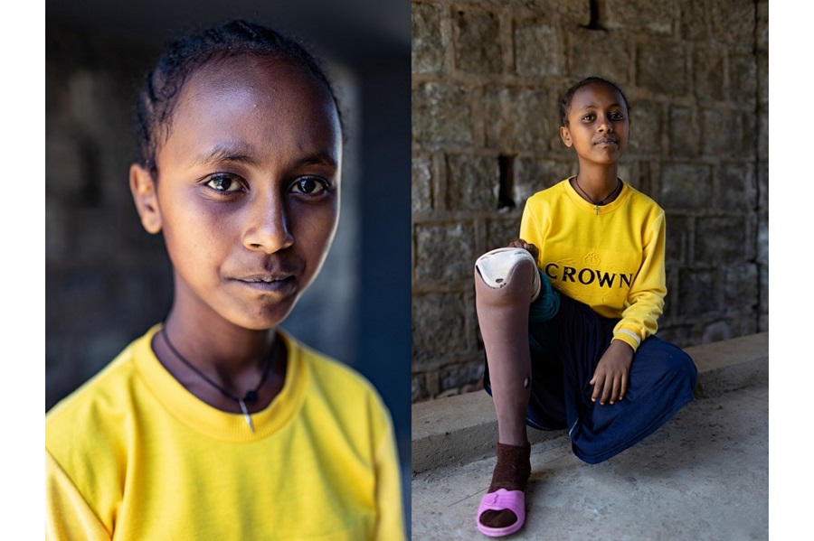 Philippines, Ethiopia, Haiti: Bringing mobility to children with limb loss | © Matilde Simas, USA, for Limb Kind Foundation Philippines, Ethiopia, Haiti: Bringing mobility to children with limb loss