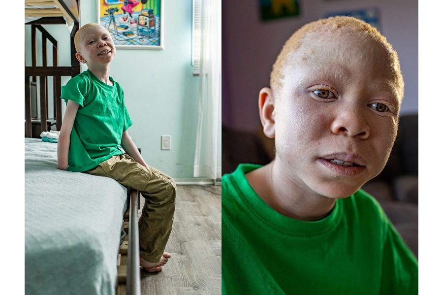 Philippines, Ethiopia, Haiti: Bringing mobility to children with limb loss | © Matilde Simas, USA, for Limb Kind Foundation Philippines, Ethiopia, Haiti: Bringing mobility to children with limb loss