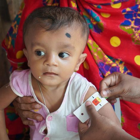 Mangelernährung in Bangladesch: Mithilfe eines Maßbands wird bei einem Kind der Armumfang gemessen.