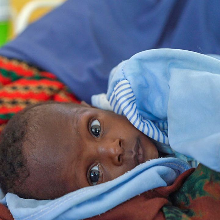 Hunger in Somalia: Dieses unterernährte Kleinkind in Somalia konnte mit Spezialnahrung gerettet werden.