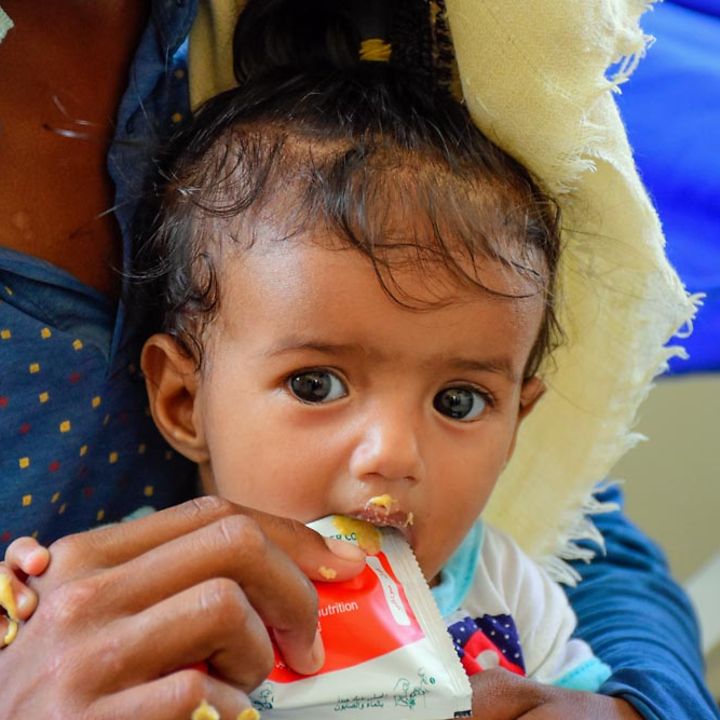 Jemen Hungersnot verhindern: Ein mangelernährtes Baby wird mit Spezialnahrung gegen den Hunger gefüttert.