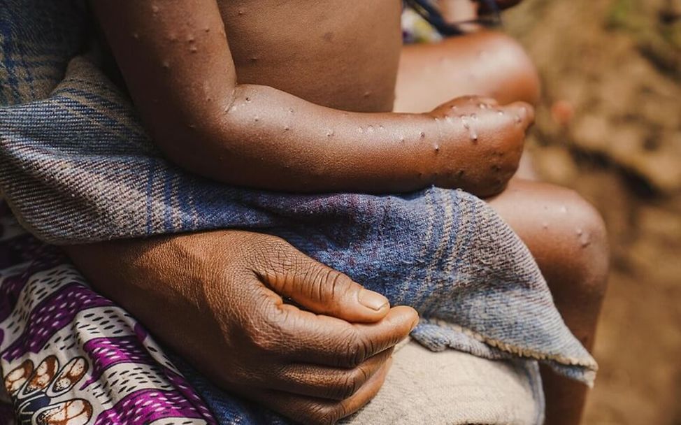 Mpox Virus: Ein erkranktes Kind auf dem Arm seiner Mutter