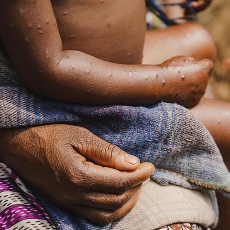 Mpox Virus: Ein erkranktes Kind auf dem Arm seiner Mutter