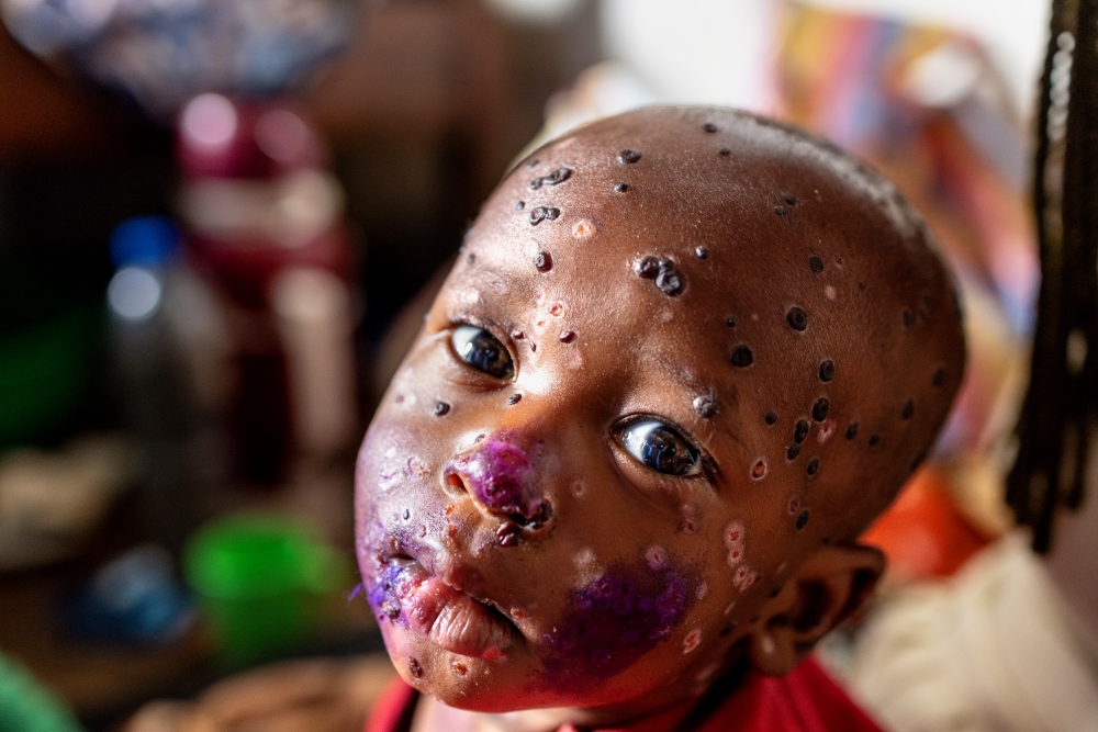 Democratic Republic of the Congo: A virus on the rise | © Pascal Maitre, France (The VII Foundation, for Paris Match) Democratic Republic of the Congo: A virus on the rise