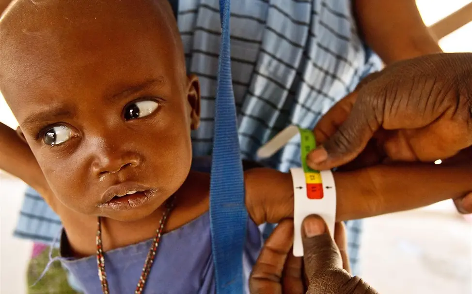 Kind wird auf Mangelernährung untersucht. ©UNICEF/Asselin Kind wird auf Mangelernährung untersucht. ©UNICEF/Asselin