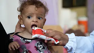 Jemen Hungersnot verhindern: Ein mangelernährtes Baby wird mit Spezialnahrung gegen den Hunger gefüttert.