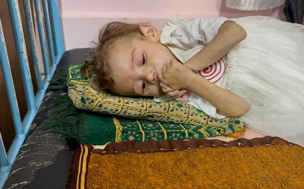 Gaza Kinder: Maryam (2) leidet an Mangelernährung.