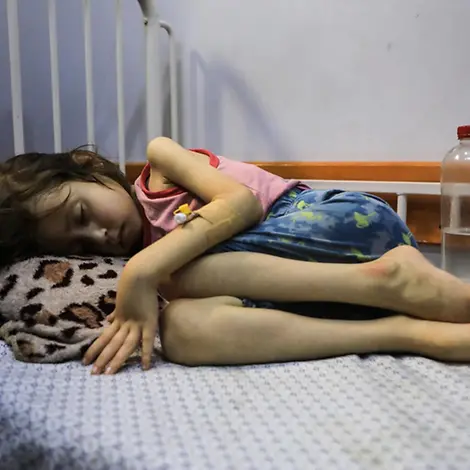Hungersnot in Gaza: Ein Mädchen liegt auf einem Krankenhausbett. Es leidet an Mangelernährung | © UNICEF/Nateel Hungersnot in Gaza: Ein Mädchen liegt auf einem Krankenhausbett. Es leidet an Mangelernährung