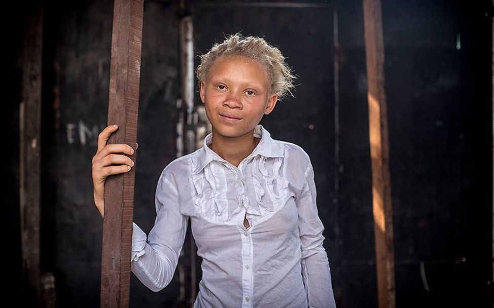 Congo: Albinism - White Ebony | © Patricia Willocq/Corbis Images