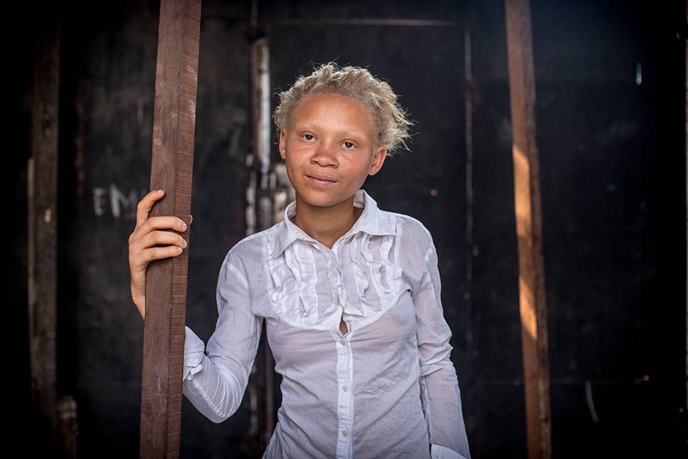 Congo: Albinism - White Ebony | © Patricia Willocq/Corbis Images