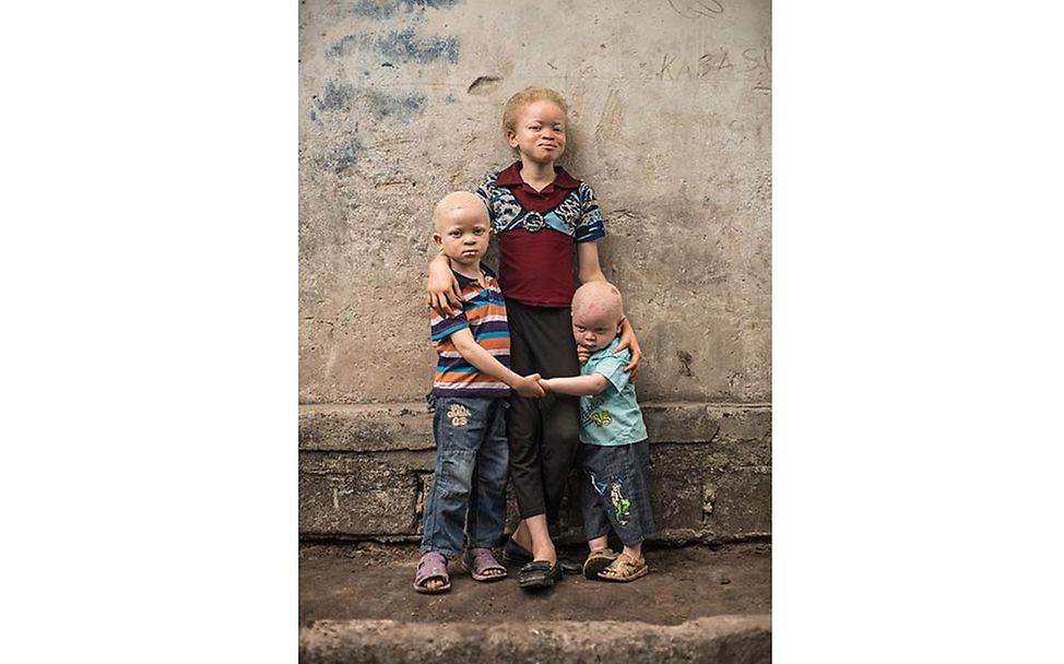 Congo: Albinism - White Ebony | © Patricia Willocq/Corbis Images