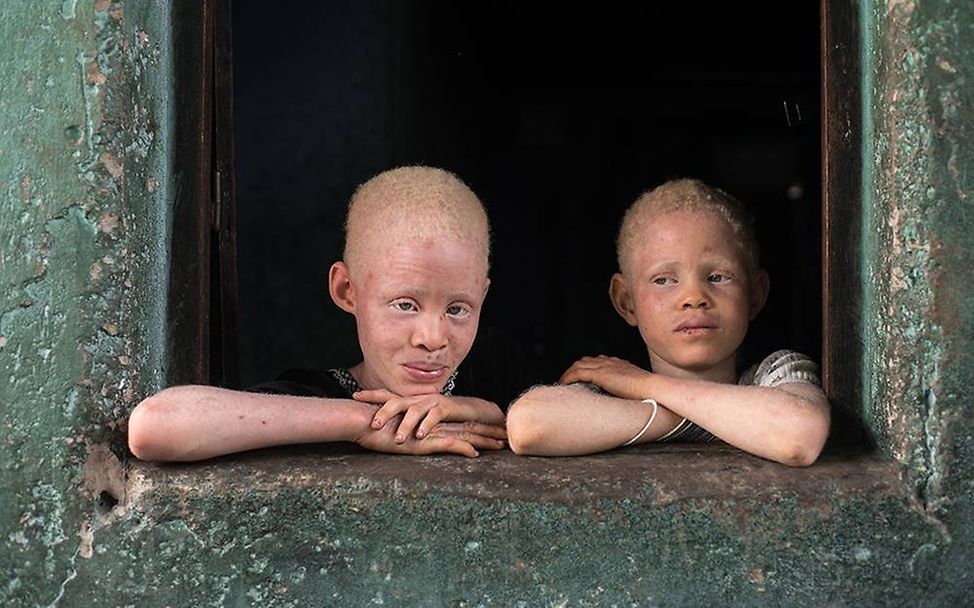 Congo: Albinism - White Ebony | © Patricia Willocq/Corbis Images