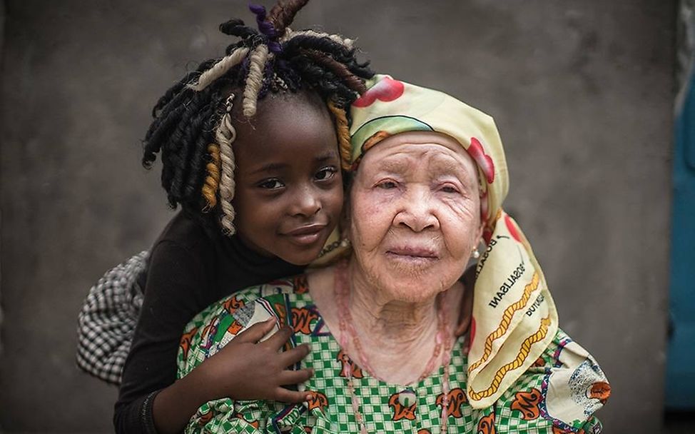 Congo: Albinism - White Ebony | © Patricia Willocq/Corbis Images