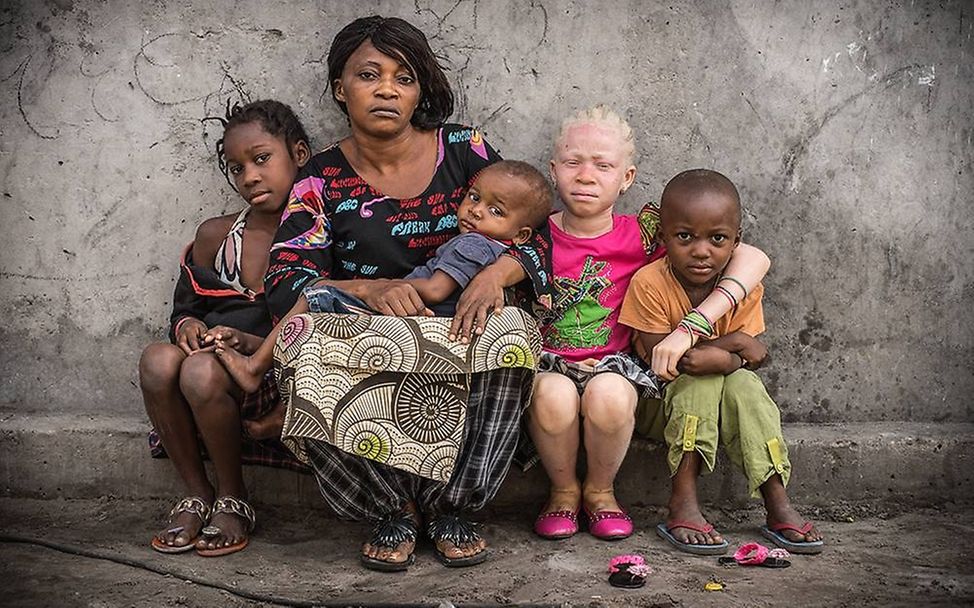 Congo: Albinism - White Ebony | © Patricia Willocq/Corbis Images