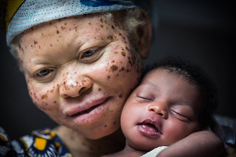 Congo: Albinism - White Ebony | © Patricia Willocq/Corbis Images