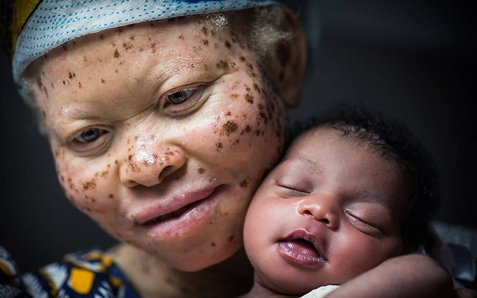 Congo: Albinism - White Ebony | © Patricia Willocq/Corbis Images