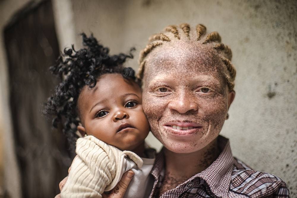 Congo: Albinism - White Ebony | © Patricia Willocq/Corbis Images