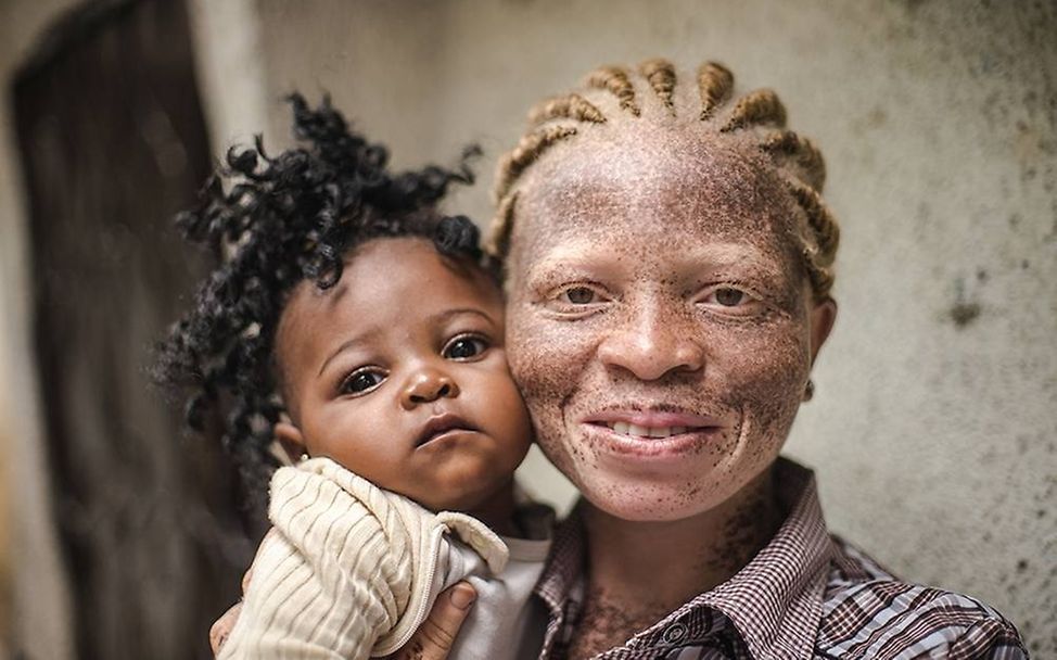 Congo: Albinism - White Ebony | © Patricia Willocq/Corbis Images