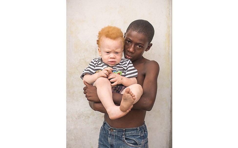 Congo: Albinism - White Ebony | © Patricia Willocq/Corbis Images