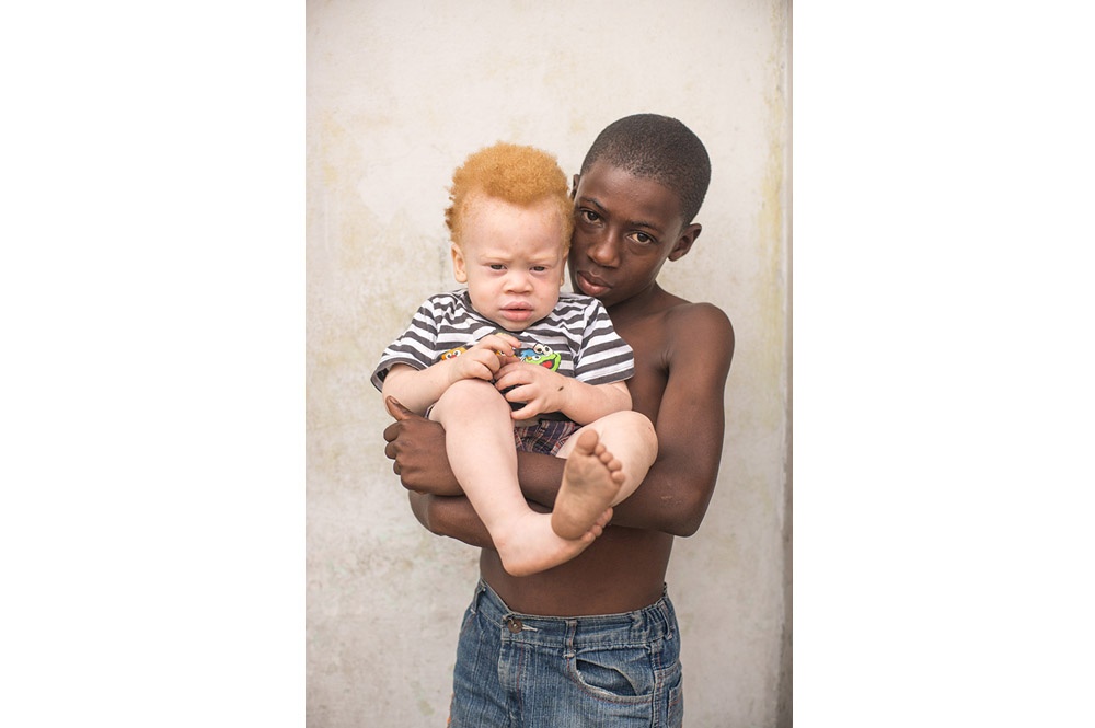 Congo: Albinism - White Ebony | © Patricia Willocq/Corbis Images