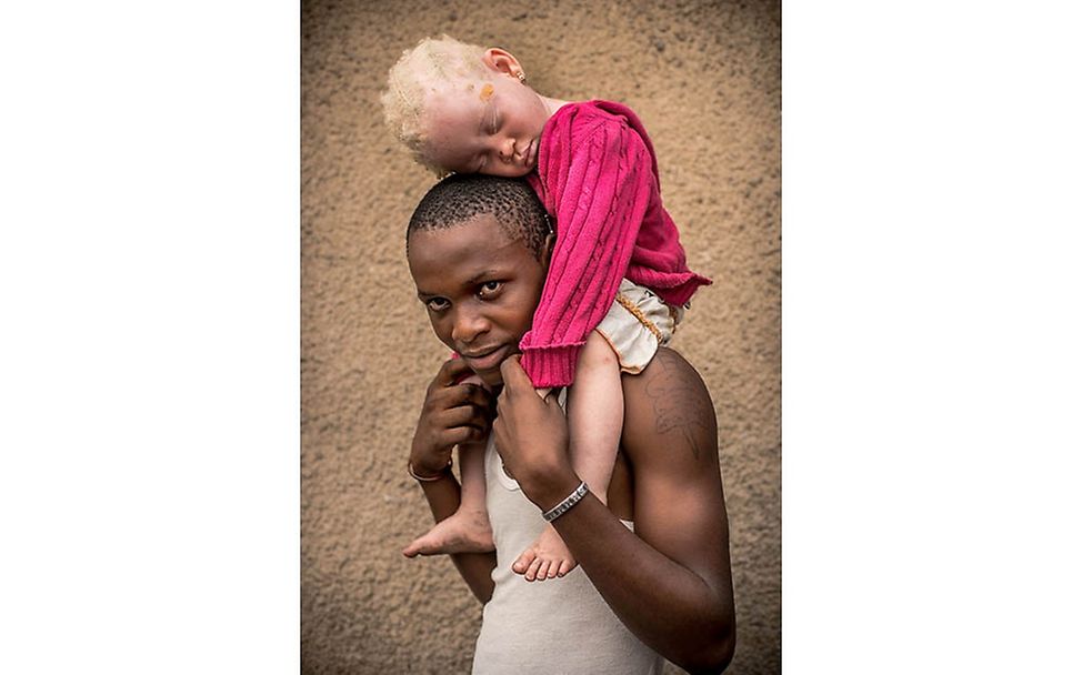 Congo: Albinism - White Ebony | © Patricia Willocq/Corbis Images