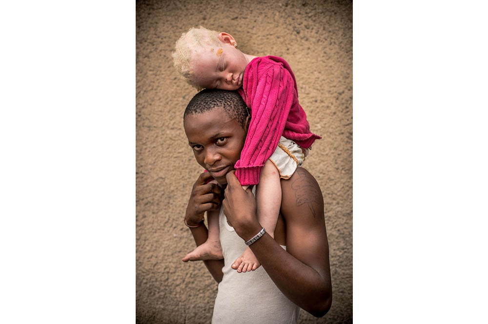 Congo: Albinism - White Ebony | © Patricia Willocq/Corbis Images