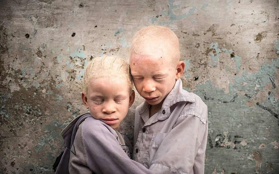 Congo: Albinism - White Ebony | © Patricia Willocq/Corbis Images