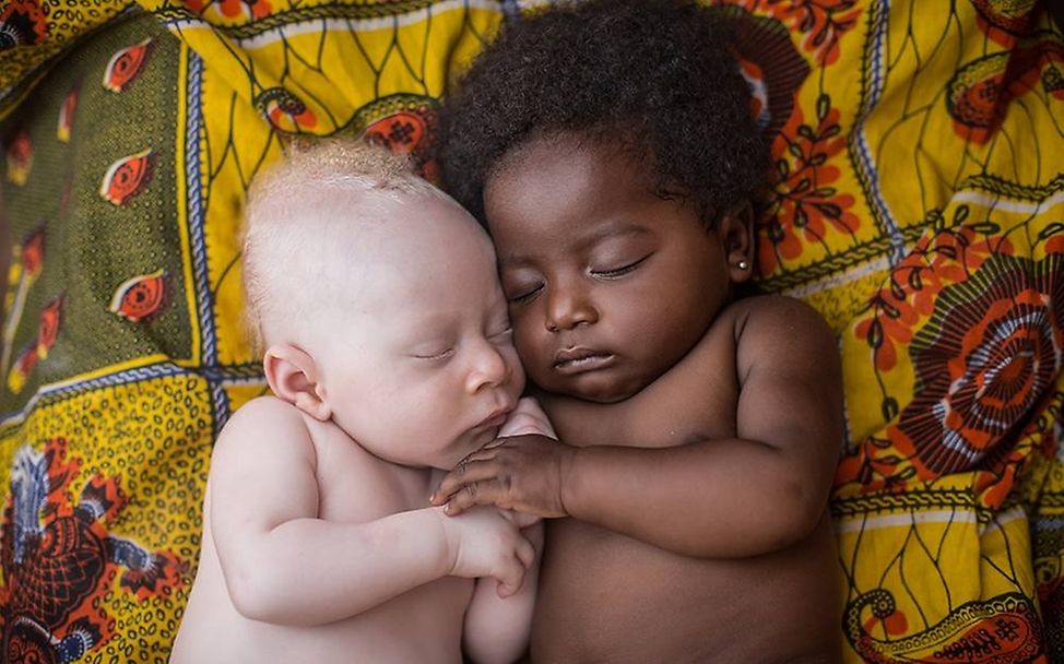 Congo: Albinism - White Ebony | © Patricia Willocq/Corbis Images