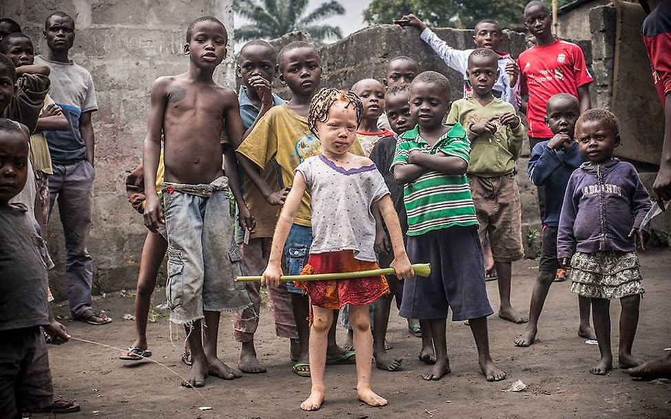 Congo: Albinism - White Ebony | © Patricia Willocq/Corbis Images