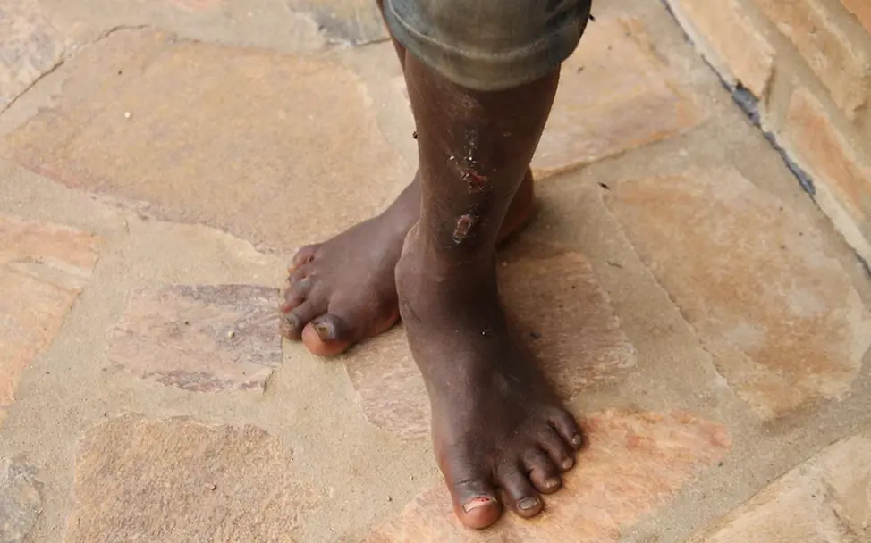 Verletztes Straßenkind in Bujumbura | © UNICEF Burundi/Luthi Burundi Krise: Straßenkinder vor Gewalt schützen